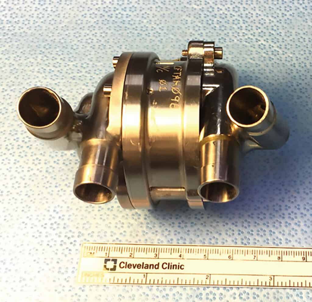 Norman Noble artificial heart pump for Cleveland Clinic