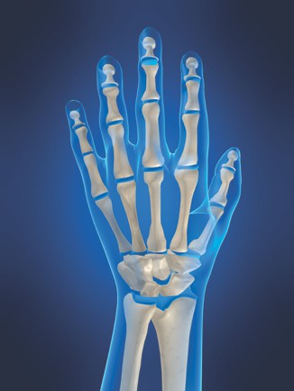 Hand Orthopedic Implants
